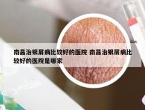 南昌治银屑病比较好的医院 南昌治银屑病比较好的医院是哪家