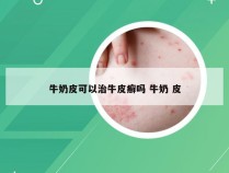 牛奶皮可以治牛皮癣吗 牛奶 皮