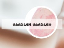 银血病怎么根除 银血病怎么根治