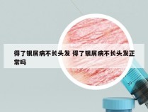 得了银屑病不长头发 得了银屑病不长头发正常吗