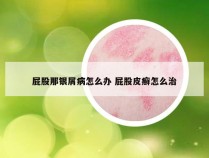 屁股那银屑病怎么办 屁股皮癣怎么治