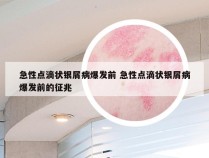 急性点滴状银屑病爆发前 急性点滴状银屑病爆发前的征兆