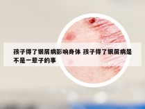 孩子得了银屑病影响身体 孩子得了银屑病是不是一辈子的事