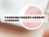牛皮癣银屑病能打新冠疫苗吗 皮肤银屑病可以打新冠疫苗吗