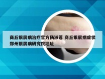 商丘银屑病治疗官方杨淑莲 商丘银屑病症状郑州银屑病研究院地址