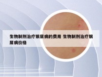 生物制剂治疗银屑病的费用 生物制剂治疗银屑病价格