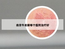 南京牛皮廨哪个医院治疗好