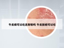 牛皮癣可以吃息斯敏吗 牛皮肤癣可以吃