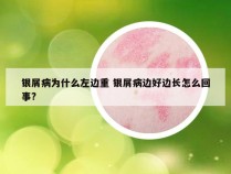 银屑病为什么左边重 银屑病边好边长怎么回事?