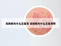 皮肤癣为什么总复发 皮肤癣为什么总复发呢