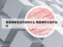 银屑病用电治疗的叫什么 银屑病可以电疗治疗