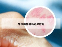 牛皮癣排骨汤可以吃吗