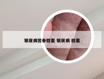 银屑病苦参胶囊 银屑病 胶囊