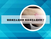 银屑病怎么是好转 银屑病怎么是好转了