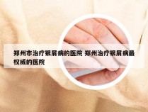 郑州市治疗银屑病的医院 郑州治疗银屑病最权威的医院