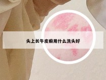 头上长牛皮癣用什么洗头好