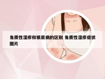 角质性湿疹和银屑病的区别 角质性湿疹症状图片