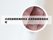 点滴型副银屑病的特点 点滴型副银屑病自愈吧