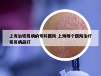 上海治银屑病的专科医院 上海哪个医院治疗银屑病最好