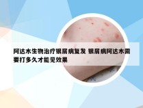 阿达木生物治疗银屑病复发 银屑病阿达木需要打多久才能见效果