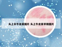 头上长牛皮屑图片 头上牛皮屑早期图片