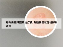 郑州白癜风西京治疗费 白颠疯症状分析郑州西京