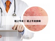 腿上牛皮廯 腿上牛皮肤癣