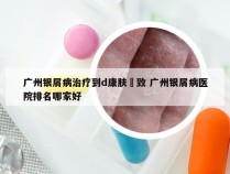 广州银屑病治疗到d康肤細致 广州银屑病医院排名哪家好