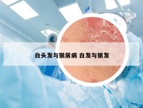 白头发与银屑病 白发与银发