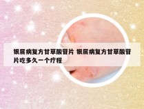 银屑病复方甘草酸苷片 银屑病复方甘草酸苷片吃多久一个疗程