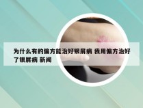 为什么有的偏方能治好银屑病 我用偏方治好了银屑病 新闻