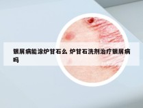 银屑病能涂炉甘石么 炉甘石洗剂治疗银屑病吗