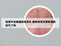 轻微牛皮癣扁桃体发炎 扁桃体发炎银屑病就好不了吗