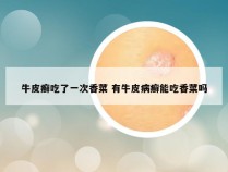 牛皮癣吃了一次香菜 有牛皮病癣能吃香菜吗