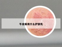 牛皮癣用什么护肤乳
