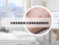 红斑皮银屑病 红斑银屑病初期症状