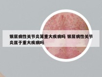 银屑病性关节炎算重大疾病吗 银屑病性关节炎属于重大疾病吗