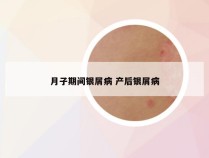 月子期间银屑病 产后银屑病
