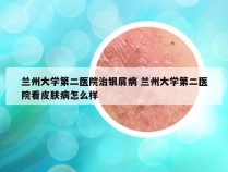 兰州大学第二医院治银屑病 兰州大学第二医院看皮肤病怎么样