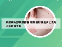 银屑病头部四肢都有 银屑病好转是头上先好还是四肢先好