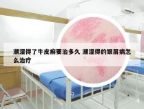 潮湿得了牛皮癣要治多久 潮湿得的银屑病怎么治疗