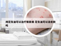 纯花生油可以治疗银屑病 花生油可以涂皮肤吗