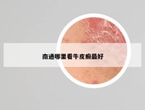 南通哪里看牛皮癣最好