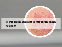武汉有名的银屑病医院 武汉有名的银屑病医院有哪些