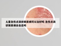儿童急性点滴状银屑病可以治好吗 急性点滴状银屑病会自愈吗