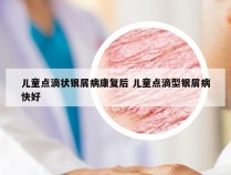 儿童点滴状银屑病康复后 儿童点滴型银屑病快好