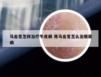 马齿苋怎样治疗牛皮癣 用马齿苋怎么治银屑病