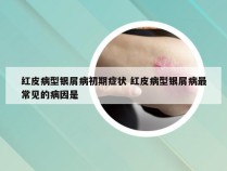 红皮病型银屑病初期症状 红皮病型银屑病最常见的病因是