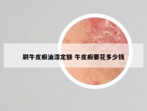 刷牛皮癣油漆定额 牛皮癣要花多少钱