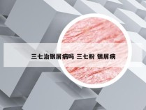 三七治银屑病吗 三七粉 银屑病